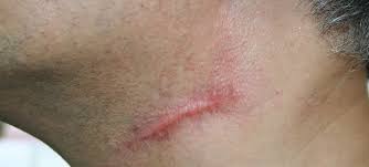 keloid scar removal keloid treatment