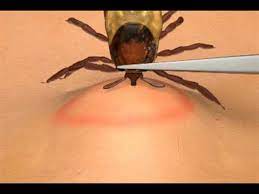 how to remove a tick you