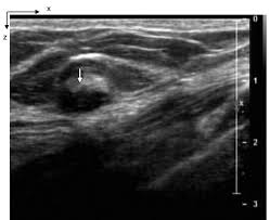 Both the mammogram and ultrasound looked fuzzy and gray on the screen and i have no idea how they determined the lump was just a benign cyst (thank god). Early Stage Invasive Breast Cancers Potential Role Of Optical Tomography With Us Localization In Assisting Diagnosis Radiology