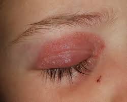 eyelid tinea with blepharitis due to