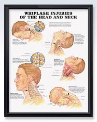 Whiplash Injuries Of The Head And Neck Chart 20x26
