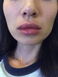 is severe swelling after restylane lip