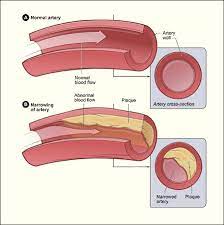 coronary artery disease cad causes