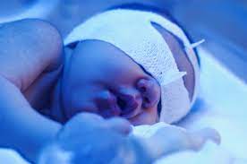 newborn neonatal jaundice