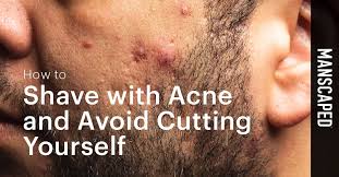 how to shave with acne and avoid