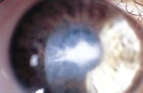 unilateral keratoconus in a child with