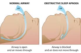 Image result for nose breathing vs mouth breathing