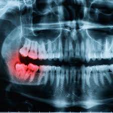 wisdom tooth removal in houston piney