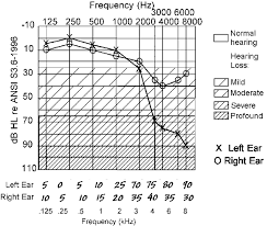 14 Audiogram Asymmetric Depicting High Frequency Hearing
