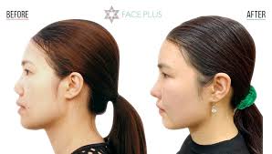 flat nose surgery face plus clinic korea