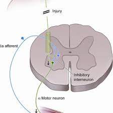 upper motor neuron injury