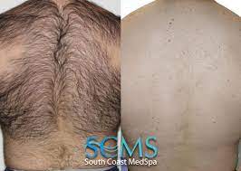 You'll find laser hair removal doctors and other providers all over los angeles, but most are near beverly hills and central la. Laser Hair Removal For Men Los Angeles Orange County Virtually Pain Free Chest Hair Removal Back Hair Removal Facial Hair Removal Leg And Bikini Hair Removal