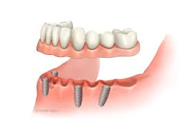 false teeth denture alternatives