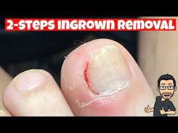 how to remove an ingrown toenail you