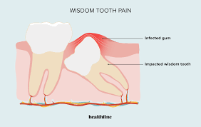 wisdom tooth pain relief treatment