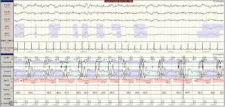 Polysomnograph Chart View By Patients A New Educational