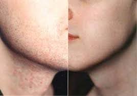 Laser hair removal can help minimise the effects of folliculitis on hair follicles. Laser Hair Removal Indianapolis Carmel Westfield Zionsville Fishers In