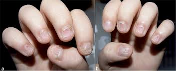 lichen pl with severe nail