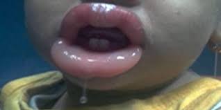 acmt toxicology visual pearl swollen lips