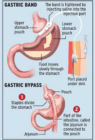 A common bariatric surgery is gastric bypass. Two Million Obese Brits To Get Free Gastric Band Operations On The Nhs Mirror Online
