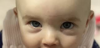 9 month old has bags under eyes mumsnet