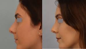 long term results after rhinoplasty