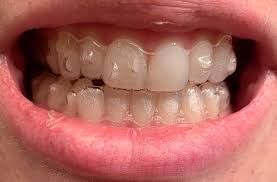 Gap teeth, or diastema, are spaces between the two front teeth. Gap Between Front Of Teeth And Trays On The Front Of My Bottom Teeth You Can See A Space Where There S Condensation Between My Tray And My Teeth Trays Fit Snugly To