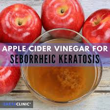 apple cider vinegar for seborrheic