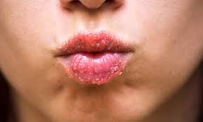 dry lip treatments 3 ways to treat