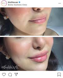 get naturally plump lips