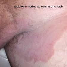 jock itch symptoms treatment