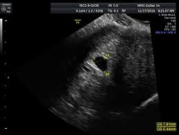 Diagnostic Ultrasound In The First Trimester Of Pregnancy