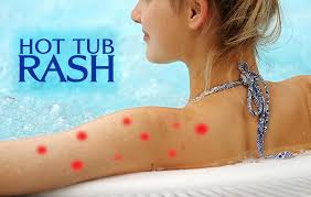 It refers to a type of folliculitis caused by using a hot tub. The Truth About Hot Tub Rash And How To Prevent It Spa Marvel