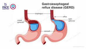 acid reflux and follow healthy lifestyle