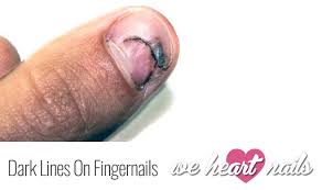 vertical lines on fingernails how to