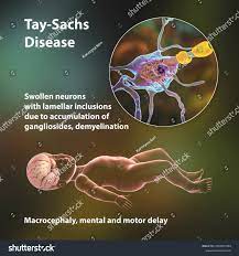 Taysachs Disease Lysosomal Storage Genetic Disorder Stock Illustration  2055957449 | Shutterstock
