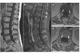 Pathogenesis, diagnosis, treatment and prognosis neurol. Guillain Barre Syndrome And Low Back Pain Two Cases And Literature Review