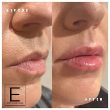 lip enhancement with dermal filler