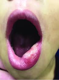 traumatic ulcer in the lower lip