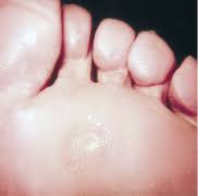 porokeratoma family foot and ankle