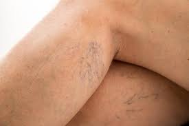 are spider veins a health risk
