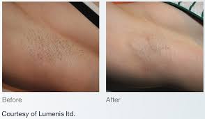 Laser hair removal won't work on blonde, white, gray, or red hair because lasers cannot effectively target. Hair Removal The Martin Center Mobile Alabama
