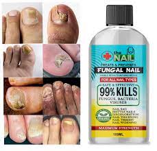 nail fungal treatment anti fungus