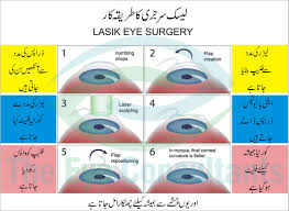 lasik eye surgery in 2024 the eye