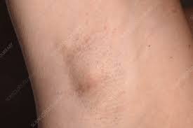 swollen lymph node stock image c056