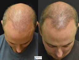 acell prp injection for hair loss hair restoration