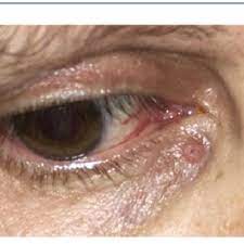 diffeial diagnosis for eyelid tumor