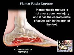 rupture of the plantar fascia