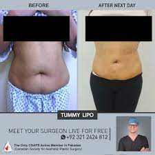 belly fat come back after a tummy tuck