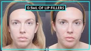 0 5ml of lip fillers